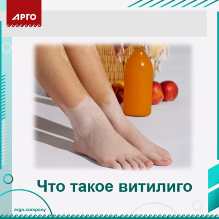 Что такое витилиго?